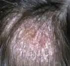 Kafa Mantarına Karşı Etkili Çözüm Yöntemleri ve Tedavi Seçenekleri Hakkında Bilgiler