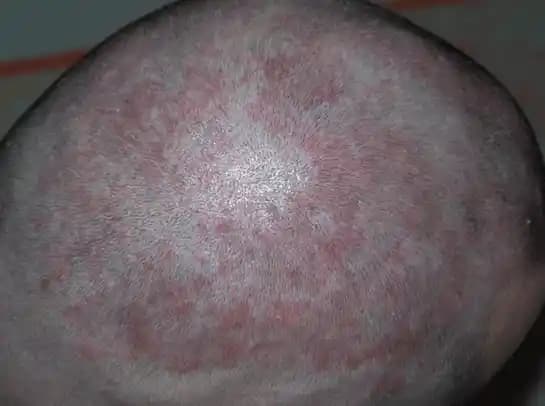 Kafada Egzema ile Mücadelede Doğru Kozmetik Yaklaşımları ve Bakım Önerileri