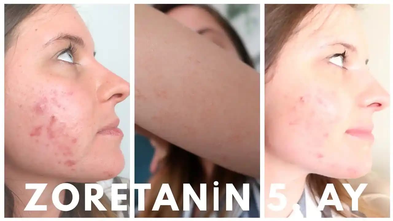 Kalıcı Sivilce İzleriyle Mücadele Yöntemleri ve Cilt Sağlığını Koruma İpuçları