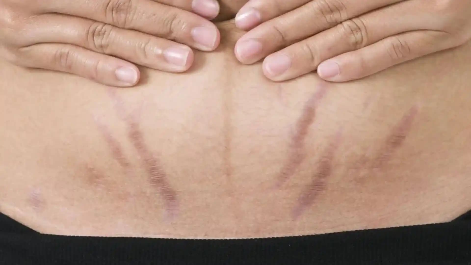 Karın Bölgesinde Kızarıklık Nedenleri ve Kozmetik Yaklaşımlarla Çözüm Yolları