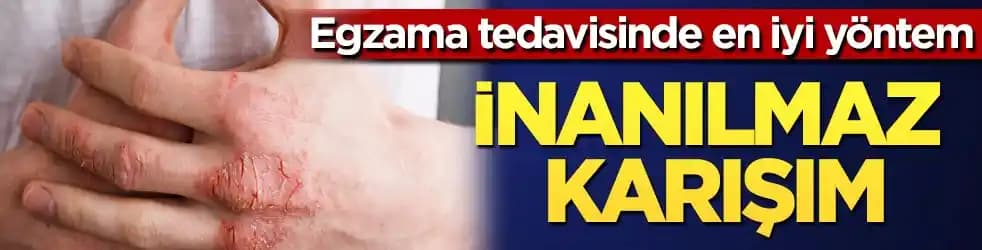 Karında Egzama Hakkında Kapsamlı Bilgi ve Cilt Sağlığı İçin Öneriler