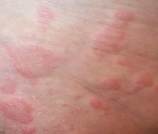 Karında Kızarıklık ve Kaşıntı Nedenleri, Tedavi Yöntemleri ve Bakım İpuçları