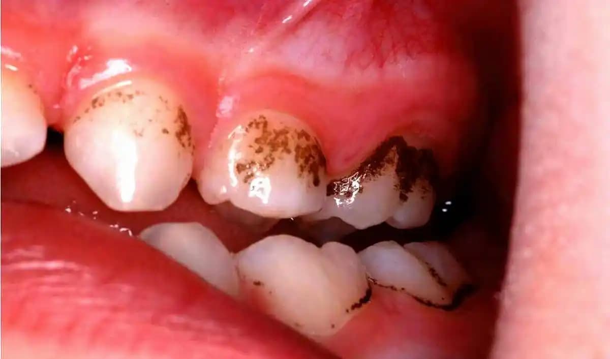 Kasık Bölgesinde Siyah Lekeler: Nedenleri ve Etkili Çözüm Yöntemleri