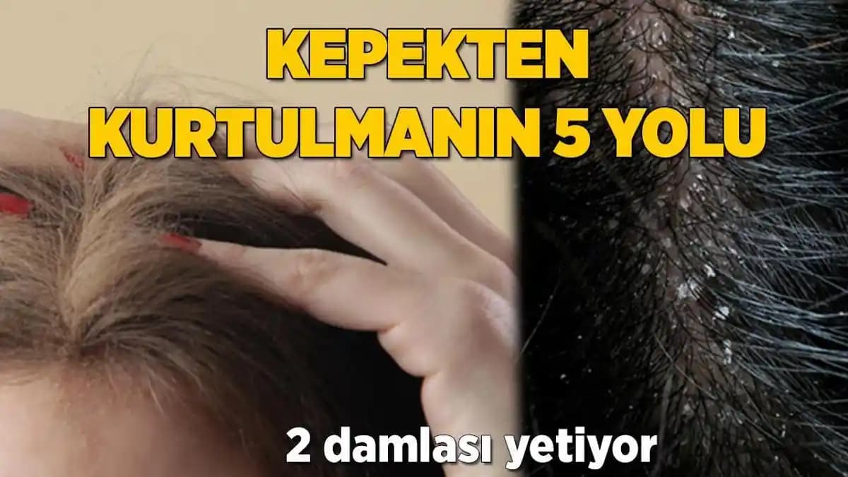 Kepek Problemi ve Çözüm Yöntemleri: Saç Sağlığını Koruma Rehberi