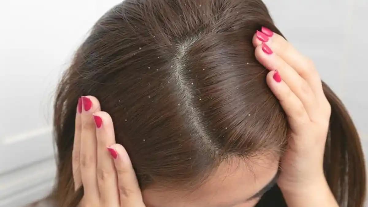 Kepekten Kurtulmanın En Etkili Yolları Sağlıklı ve Güzel Saçlar İçin İpuçları