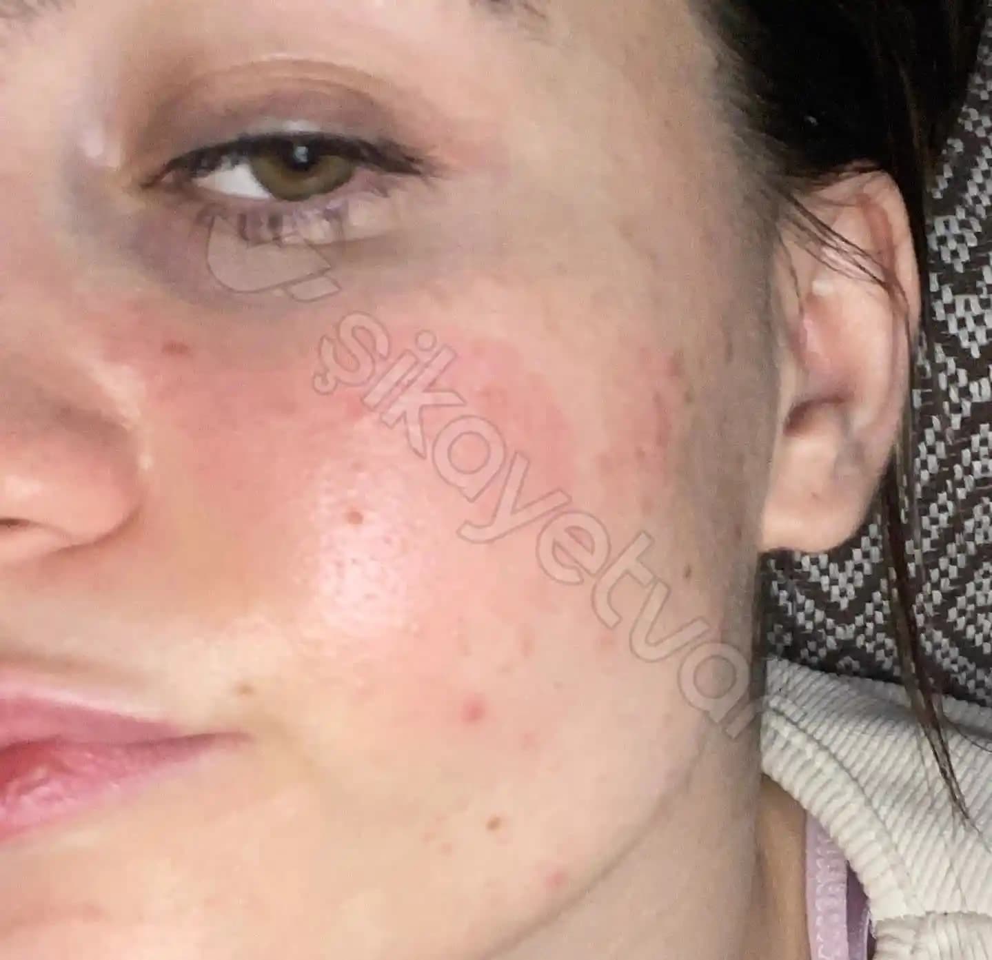 Kıl Maskesi Neden Kaşınır ve Cilt Sağlığını Koruma Yöntemleri