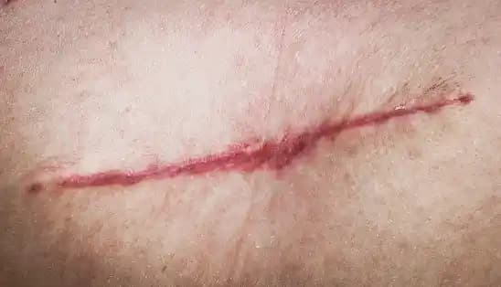 Kırmızı Yara İzleriyle Mücadelede Etkili Kozmetik ve Doğal Çözümler