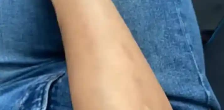 Kol Yanığı Nedir, Nedenleri, Belirtileri ve Etkili Tedavi Yöntemleri Hakkında Kapsamlı Bilgi