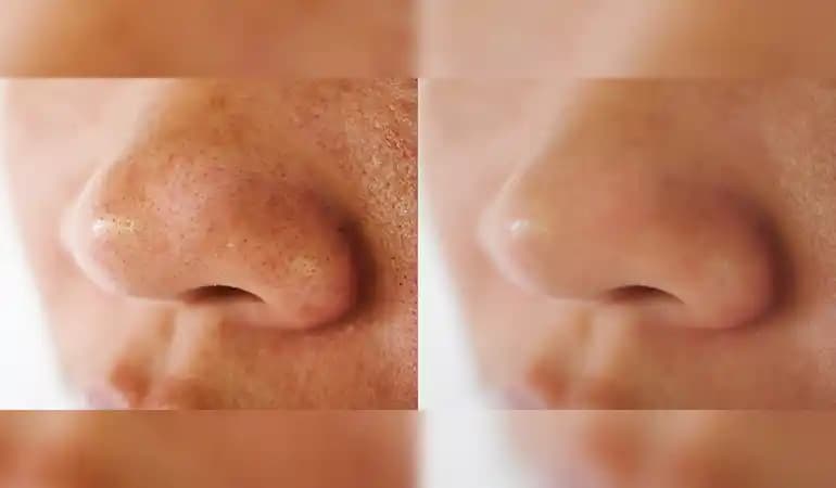 Kolda Siyah Noktalarına Karşı Etkili Bakım ve Tedavi Yöntemleri