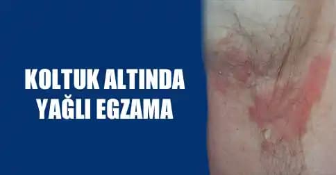 Koltuk Altı Egzaması Nedenleri Belirtileri ve Etkili Çözüm Yolları