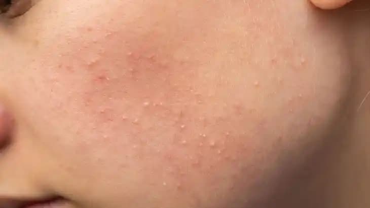 Komedonlar ve Cilt Sağlığı Üzerine Detaylı Bilgi ve Tedavi Yöntemleri