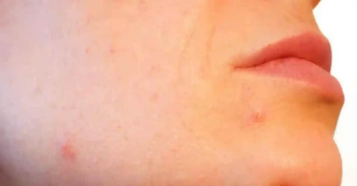 Kör Sivilceler Nasıl Geçer En Etkili ve Güvenli Çözüm Yolları