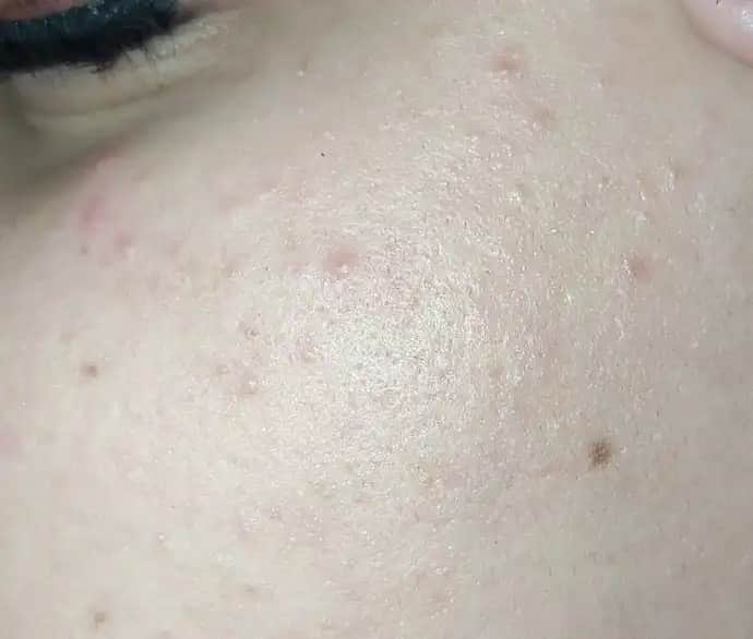 Küçük Sivilcelerle Mücadelede Etkili Yöntemler ve Cilt Bakım İpuçları