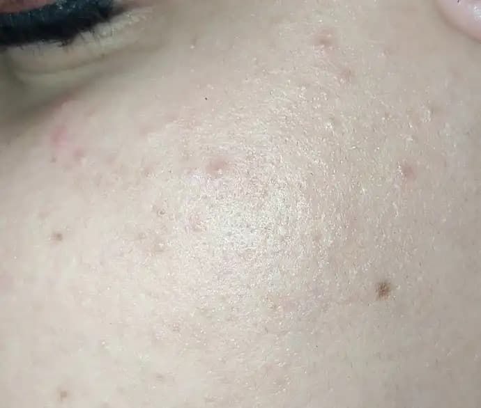 Küçük Sivilcelerle Mücadelede Etkili Yöntemler ve Cilt Bakım İpuçları