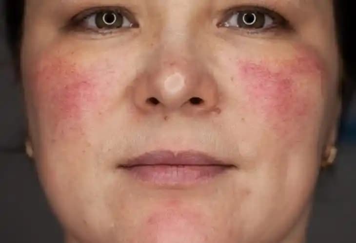 Kuperoz Nedir, Belirtileri ve Kozmetik Yaklaşımlarla Yönetimi Hakkında Bilgiler