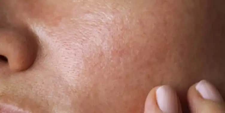 Kuru Ciltler İçin Etkili Bakım Yöntemleri ve Sağlıklı Cilt Sırları