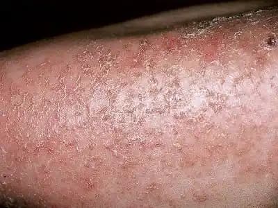 Kuru Deri Sorunu ve Doğru Kozmetik Yaklaşımlar ile Cilt Sağlığını Koruma