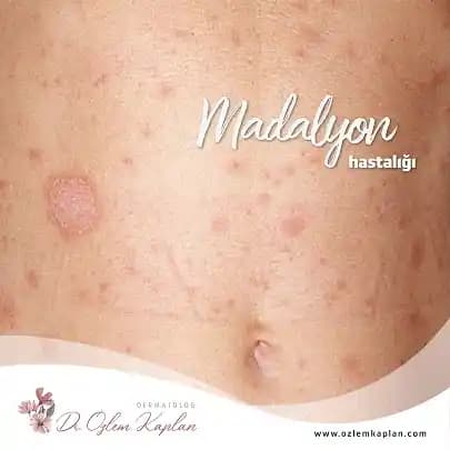 Madalyon Hastalığı ve Kozmetik Ürünleri: Cilt Sağlığını Koruma Yöntemleri ve Güncel Yaklaşımlar