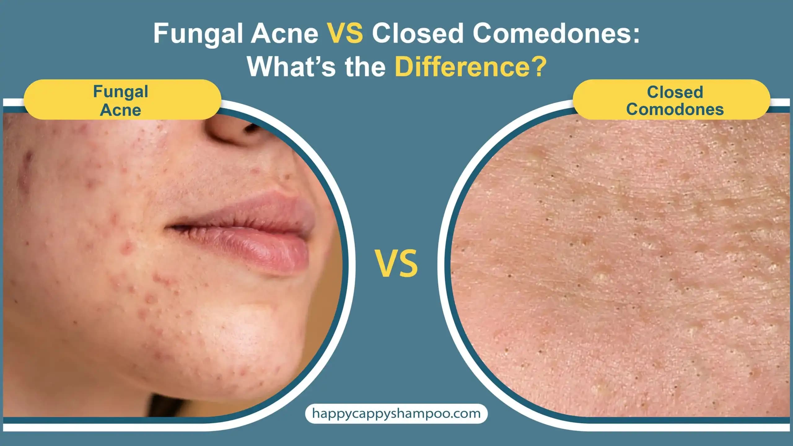 Mantar Akne Testi Nedir Cilt Sağlığını Koruma ve Doğru Tanı İçin Önemli Bilgiler