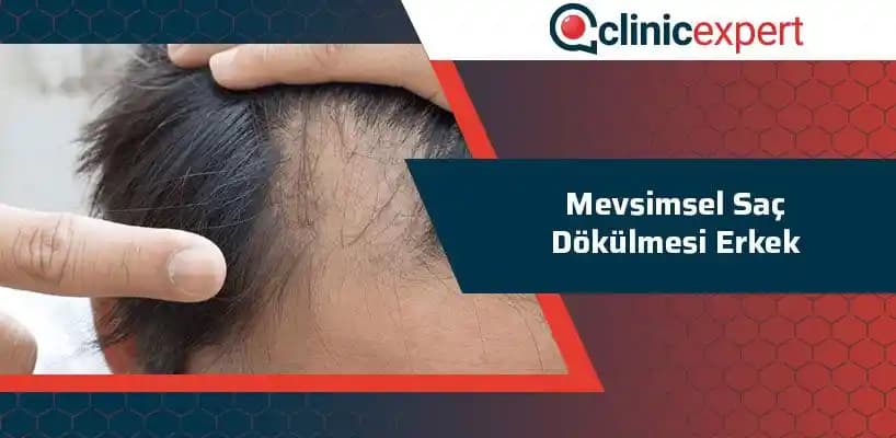 Mevsimsel Saç Dökülmesi ve Erkeklerde Nedenleri ile Alınabilecek Önlemler