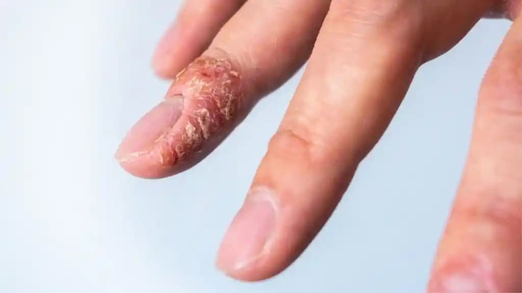 Parmak Arası Egzama Nedenleri Belirtileri ve Etkili Tedavi Yöntemleri