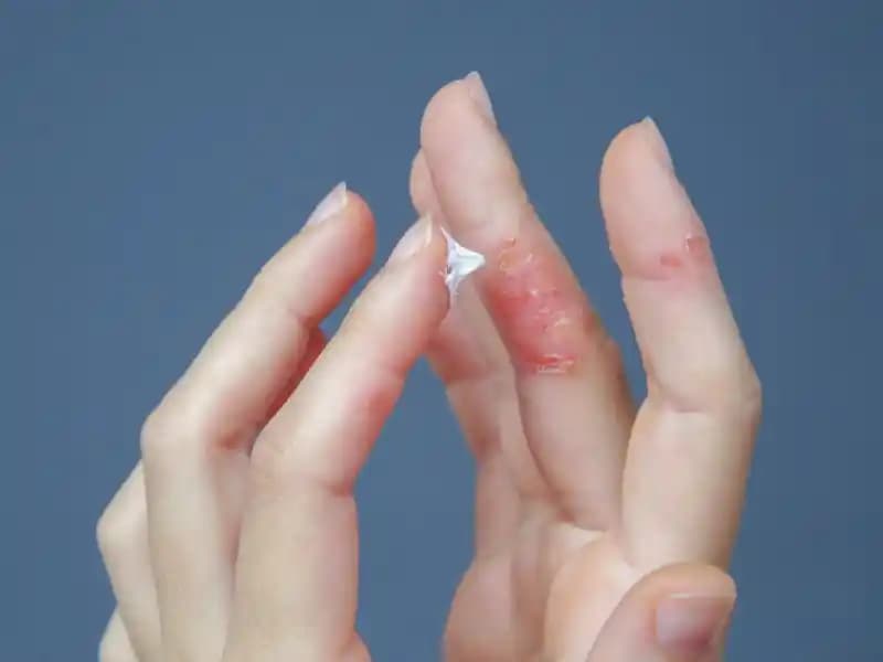 Parmak Ucunda Egzama: Nedenleri, Belirtileri ve Etkili Bakım Yöntemleri