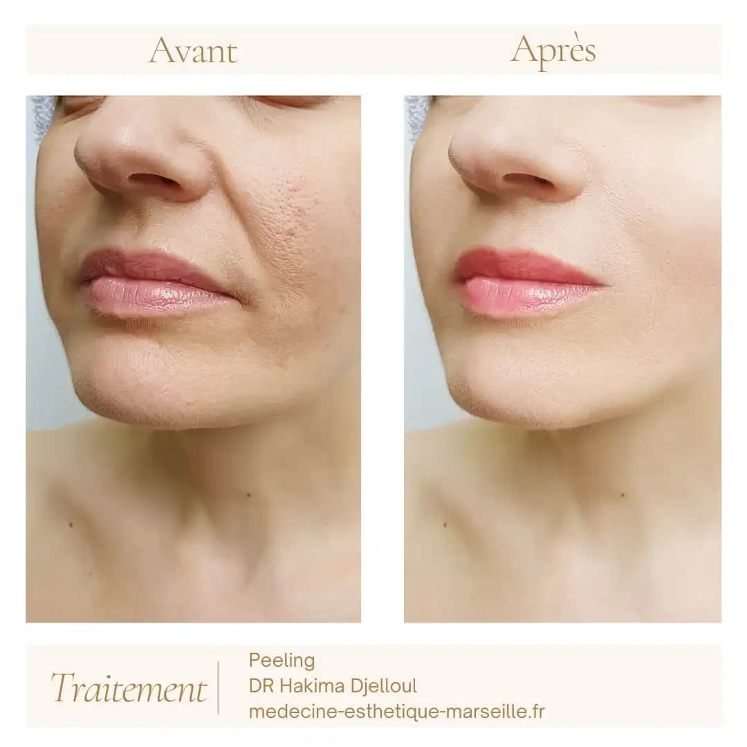 Peeling Nedir ve Cilt Sağlığını Artıran Etkili Yöntemler Nelerdir