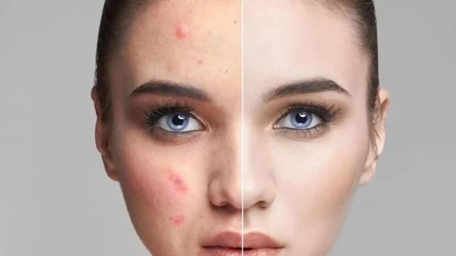 Roaccutane Sonrası Leke Tedavisi İçin En İyi Kremler ve Bakım Yöntemleri
