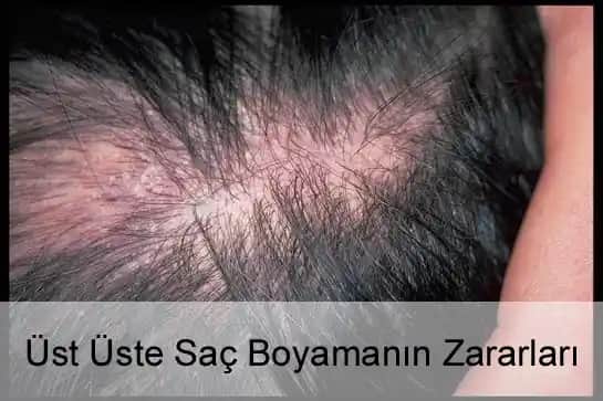 Saç Boyasının Zararları ve Saç Sağlığını Koruma Yöntemleri