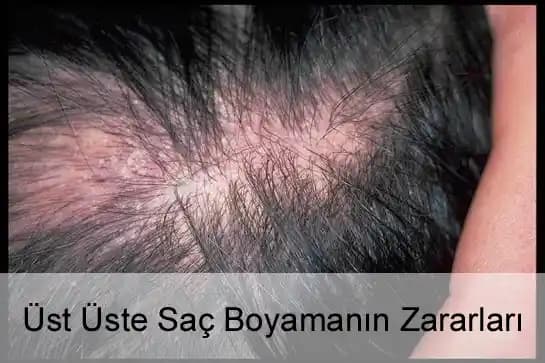 Saç Boyasının Zararları ve Saç Sağlığını Koruma Yöntemleri