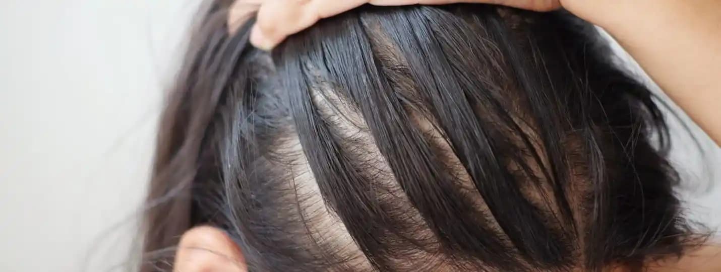 Saç Çok Yağlanması Nedenleri ve Etkili Bakım Yöntemleri Hakkında Kapsamlı Rehber