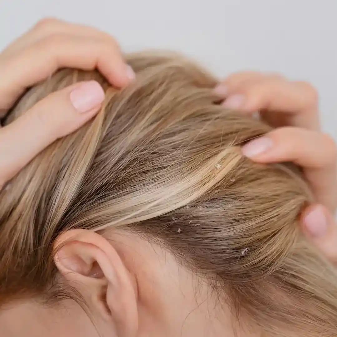 Saç Derisi Kuruluğu Nedenleri ve Etkili Önlemlerle Sağlıklı Saçlar