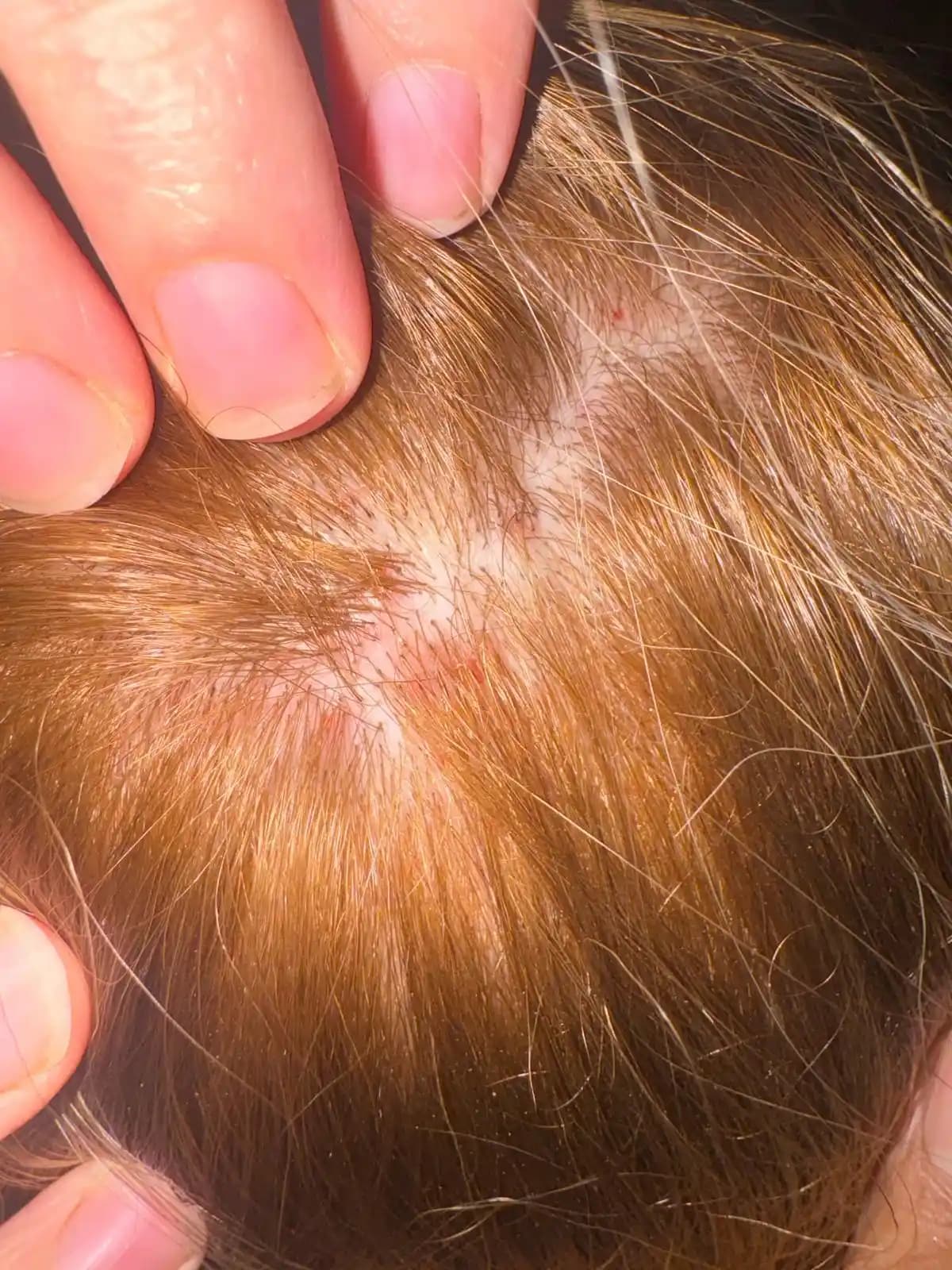 Saç Derisi Neden Ağrıyor ve Nasıl Tedavi Edilir Detaylı Bakım İpuçları