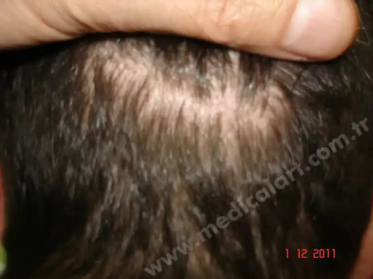 Saç Derisinde Benler: Nedenleri, Belirtileri ve Tedavi Yöntemleri