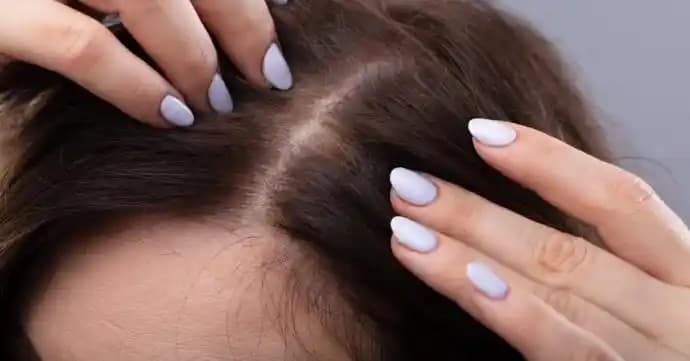 Saç Derisinde Beyaz Tortu Nedenleri ve Etkili Bakım Yöntemleri
