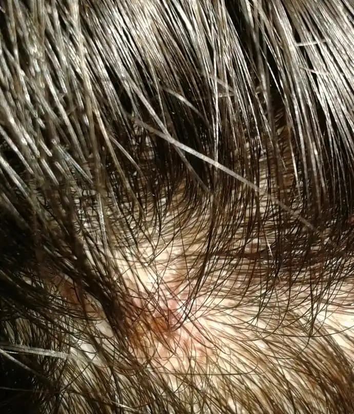 Saç Derisinde Çıkan Yaraların Nedenleri ve Etkili Çözüm Yolları