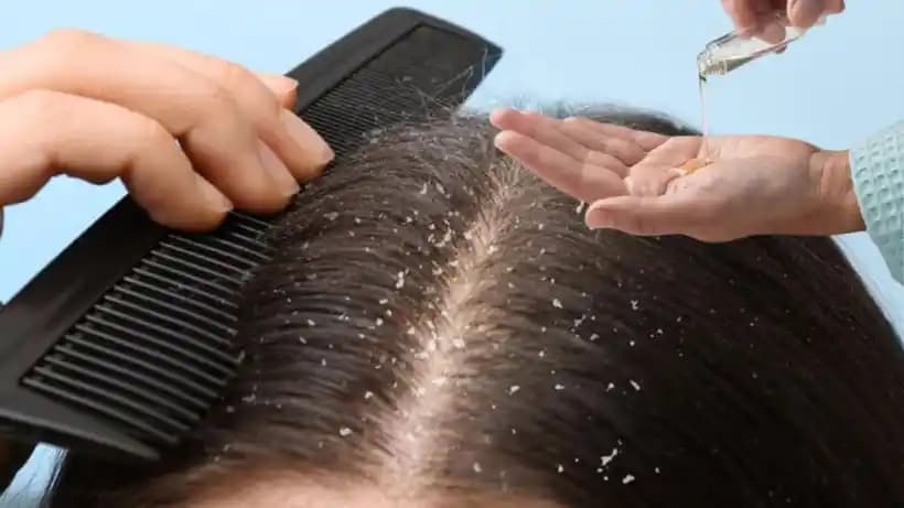 Saç Derisinde Egzama Belirtileri ve Etkili Tedavi Yöntemleri Hakkında Kapsamlı Bilgi