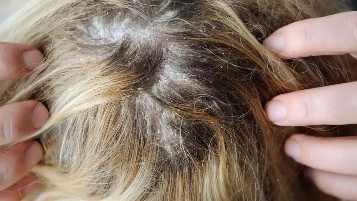 Saç Derisinde Kaşıntı ve Kepek Problemleri İçin Etkili Çözüm Yöntemleri