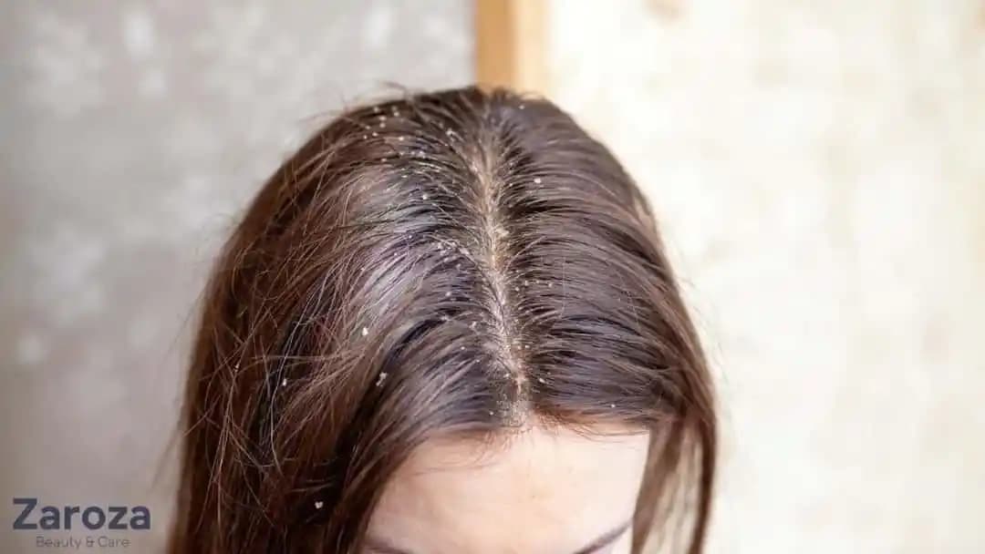 Saç Derisinde Kepek Problemi: Nedenleri, Belirtileri ve Etkili Çözüm Yöntemleri