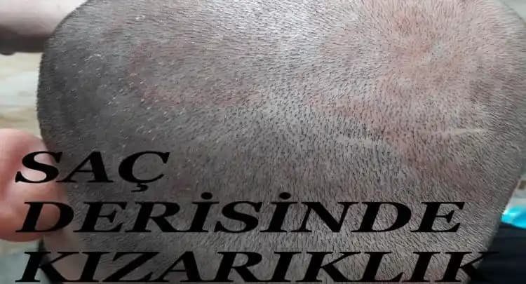 Saç Derisinde Kızarıklık ve Pullanma Nedenleri, Belirtileri ve Çözüm Yolları