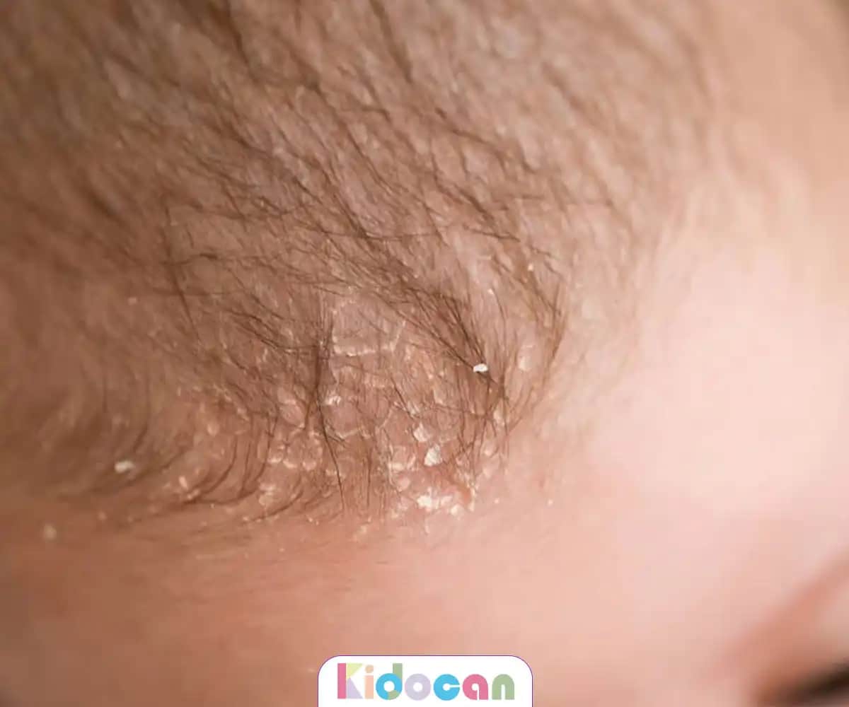 Saç Derisinde Konak Nedenleri ve Tedavi Yöntemleri Hakkında Detaylı Bilgi