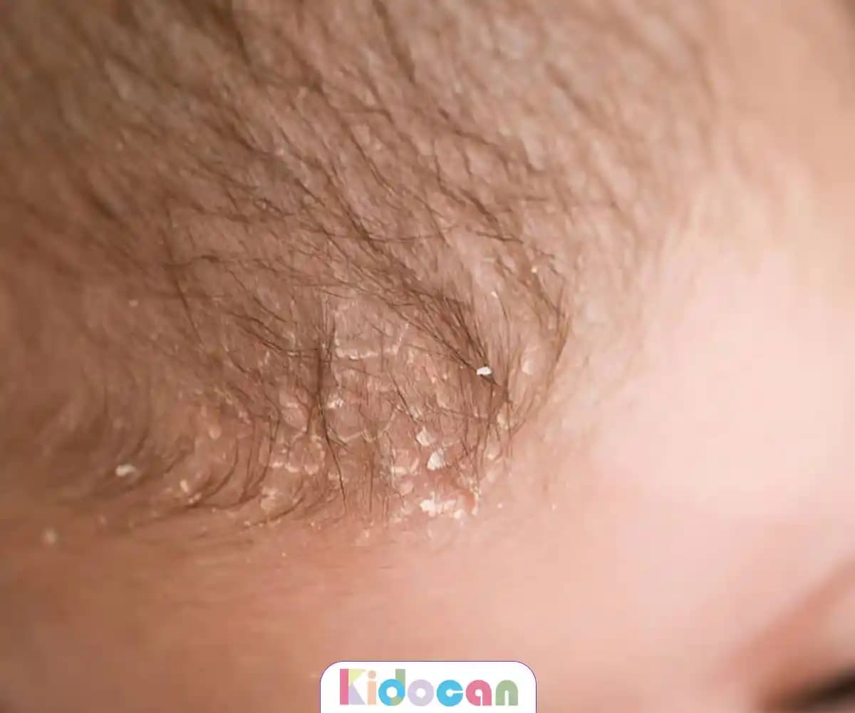 Saç Derisinde Konak Nedenleri ve Tedavi Yöntemleri Hakkında Detaylı Bilgi