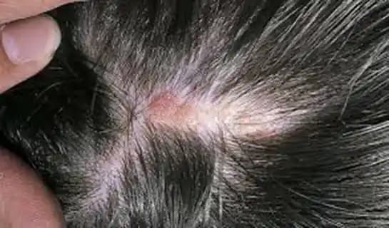 Saç Derisinde Yara Oluşumunun Nedenleri ve Korunma Yöntemleri