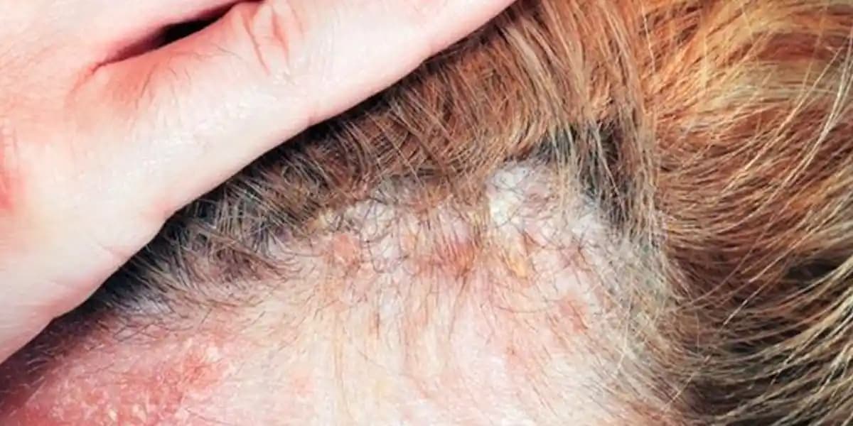 Saç Derisinde Yara ve Kabuklanma Nedenleri Belirtileri ve Etkili Tedavi Seçenekleri