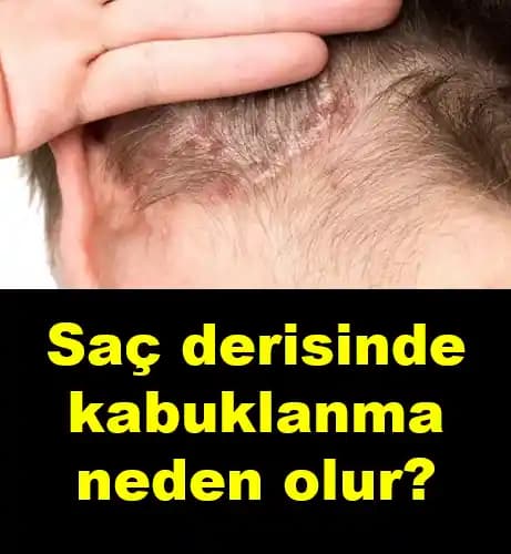 Saç Derisinin Kabuklanmasının Nedenleri ve Çözüm Yolları Hakkında Kapsamlı Bilgi