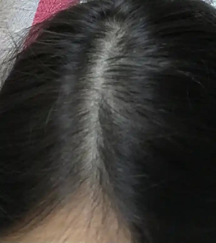 Saç Dipleri Ağrısı ve Dökülme Sorunları İçin Bilmeniz Gerekenler ve Çözüm Yolları