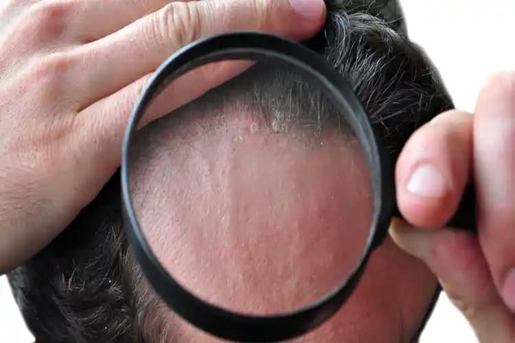 Saç Diplerindeki Sivilce Nedenleri ve Etkili Önleme Yöntemleri