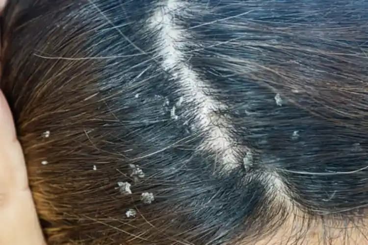 Saç Egzaması Nedir, Belirtileri ve Etkili Tedavi Yöntemleri Hakkında Bilgiler