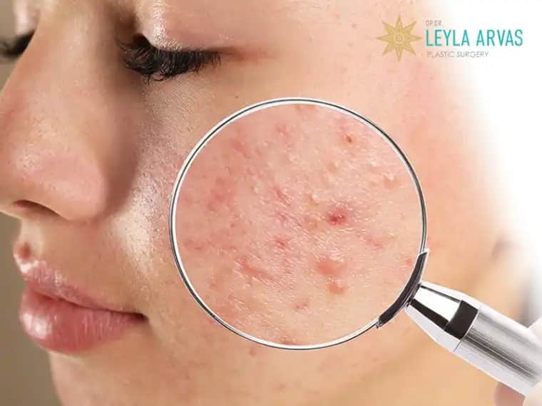 Saç İçi Sivilcelerinin Nedenleri, Belirtileri ve Etkili Çözüm Yolları