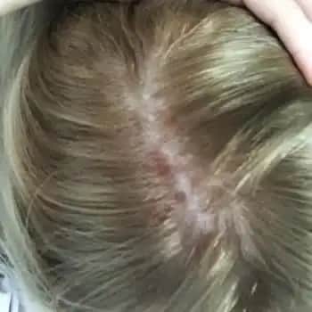 Saç İçi Yara Nedir? Belirtileri, Nedenleri ve Kozmetik Tedavi Yöntemleri